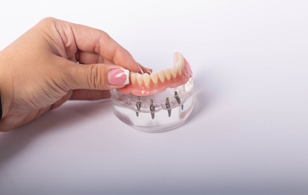 A model of dental implants sitting beneath the gums.