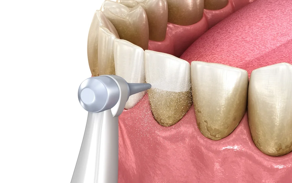 A dental cleaning procedure taking place.